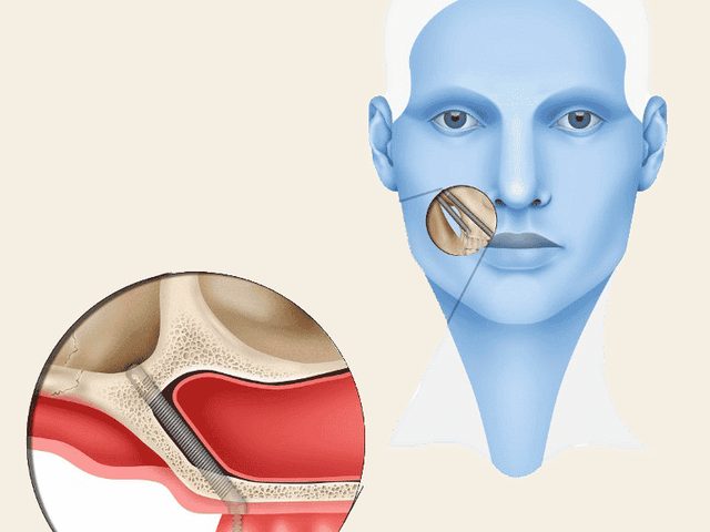 Estudio radiológico 3D para planificar implantes con pérdida ósea